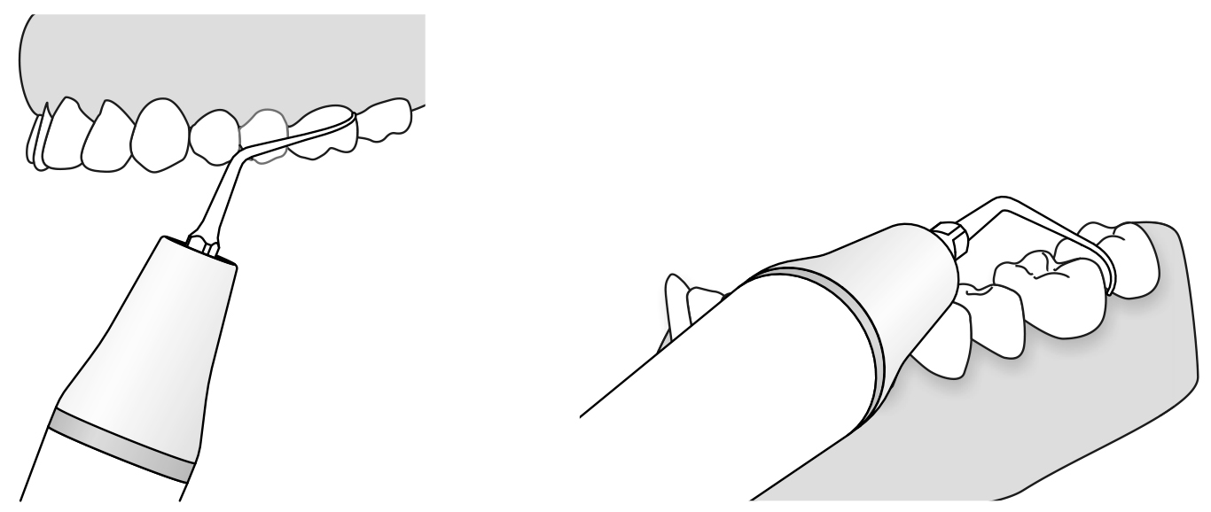 Сфера применения наконечника для скалера